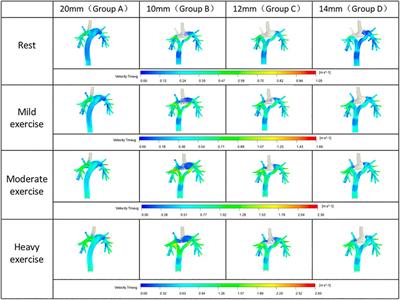 The prediction and verification of outcome of extracardiac conduits fontan based on computational fluid dynamics simulation